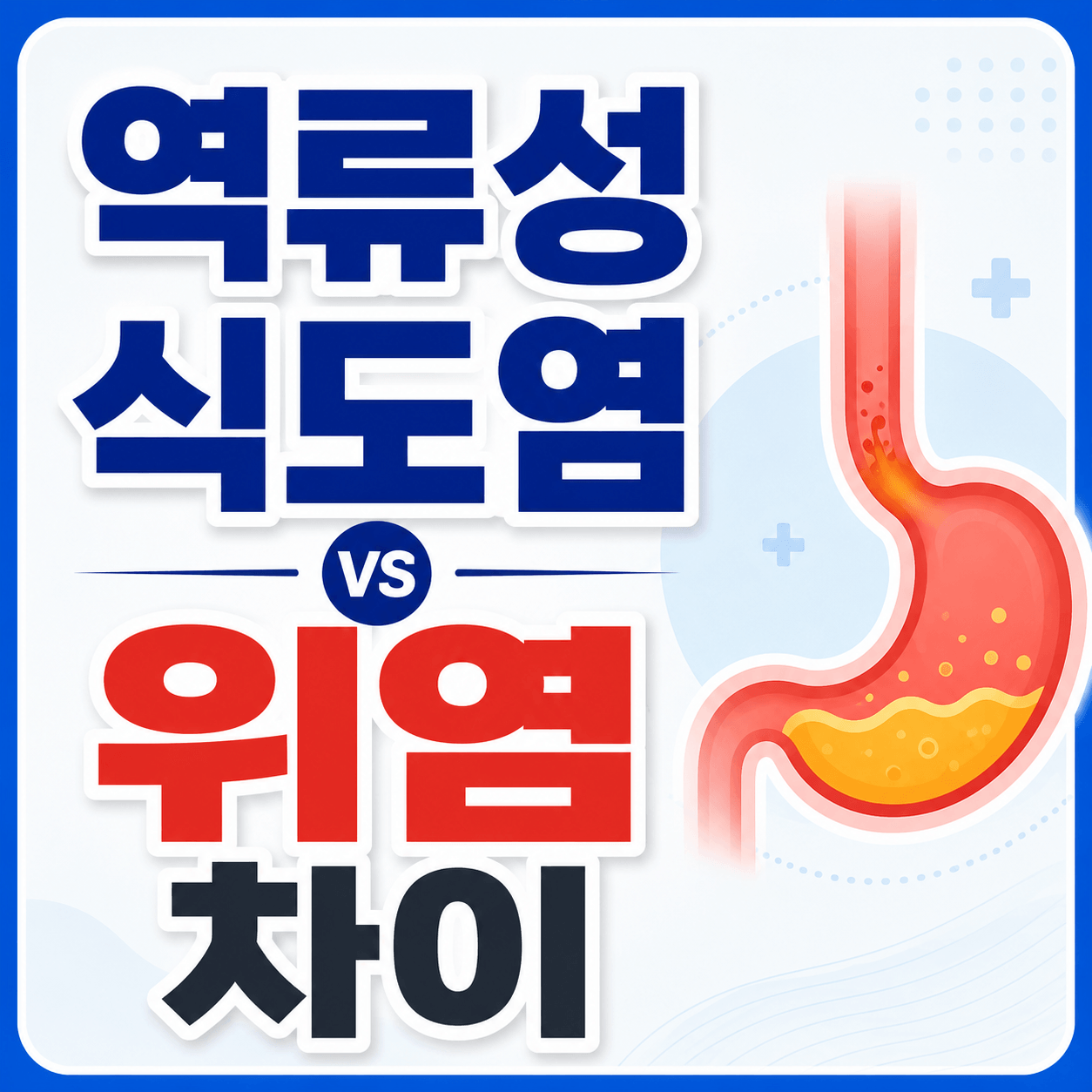 역류성 식도염 위염 차이