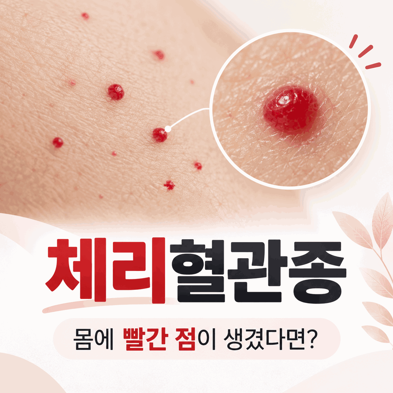 체리혈관종